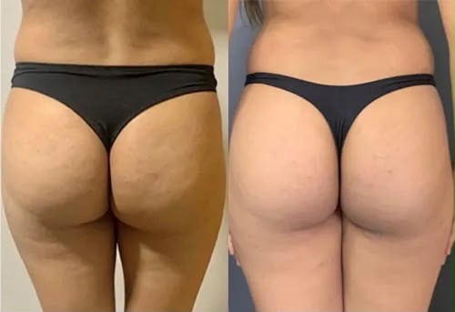 Thighs and buttocks lift before and after — Endolift at MiaBella